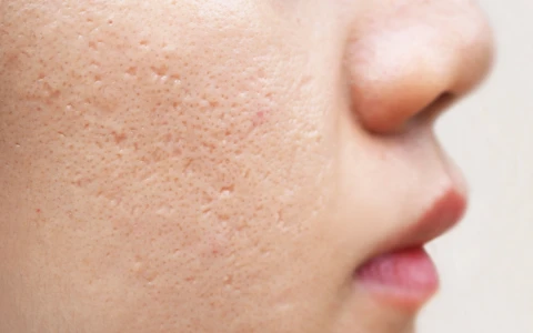 Acne & Acne Scars