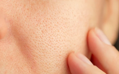 Enlarged Pores