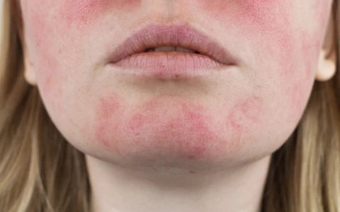 Rosacea
