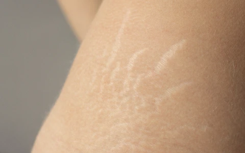 Stretch Marks