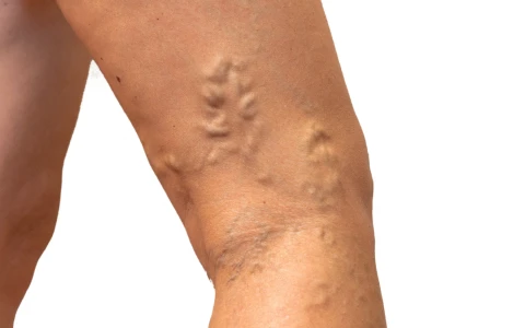 Varicose Veins